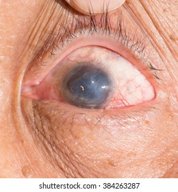 Close Phthisis Bulbi During Eye Examination Stock Photo 384263287 | Shutterstock