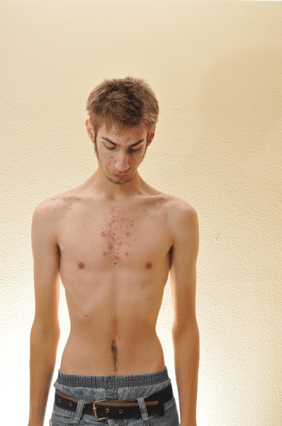 anorexic 