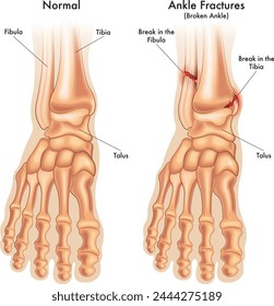 medical illustration compares a normal foot ankle, with a foot ankle fractured in two places, with annotations. 库存矢量图