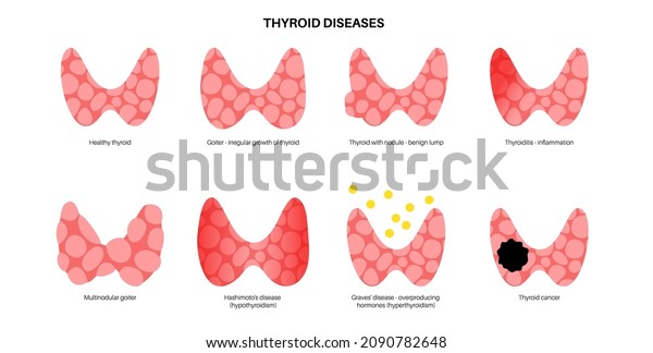 hashimoto‪˙ᵕ˙ 13.Endocrine (4) Chronic thyroiditis (Hashimoto disease