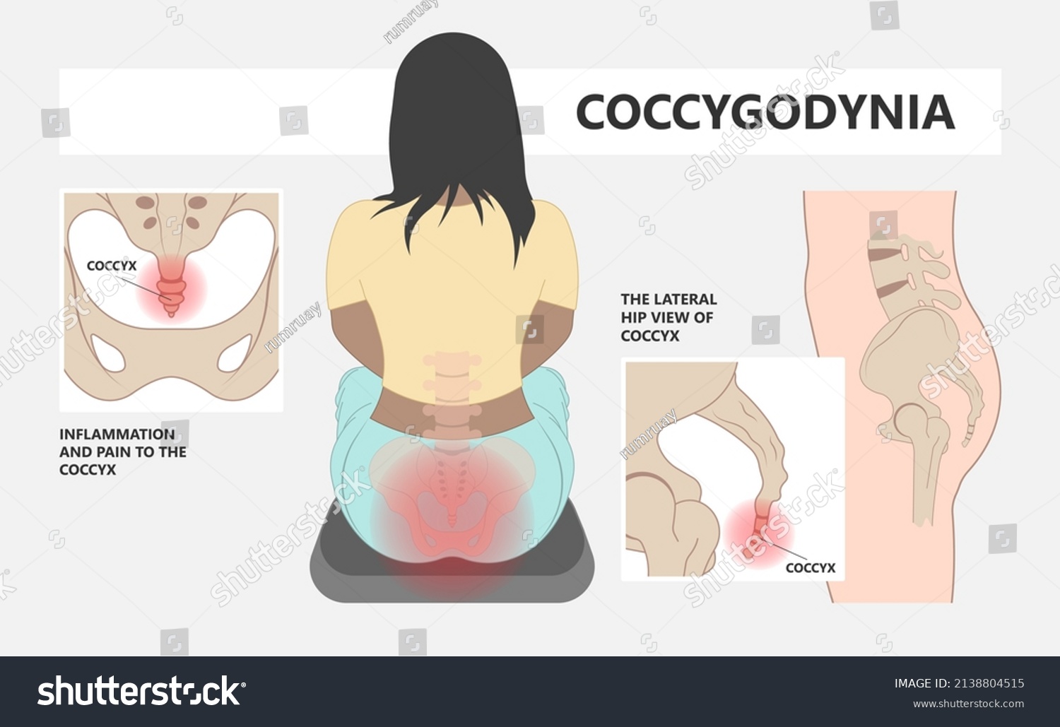 Coccyx Pain Symptoms