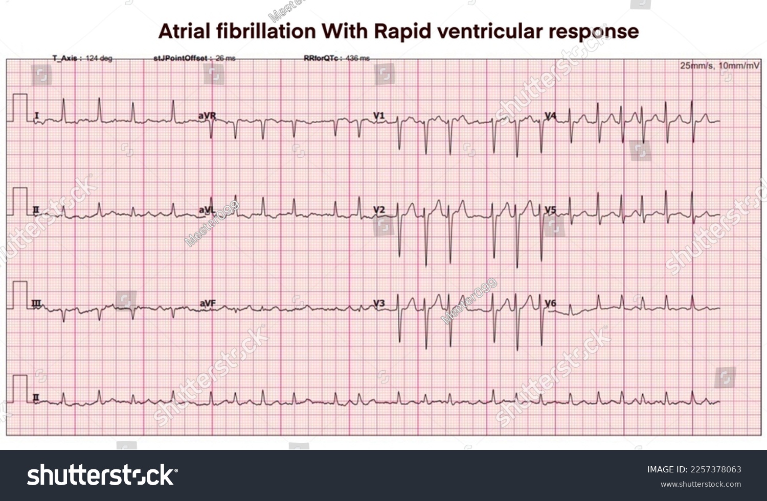 Atrial fibrillation rvr ecg